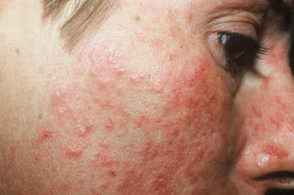 Rosacea