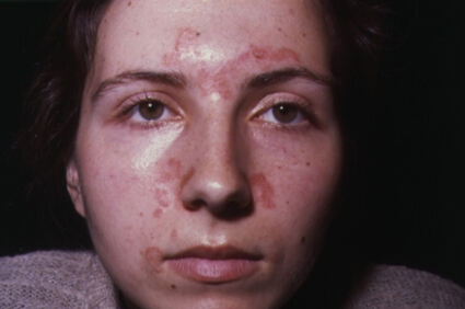 Seboroični dermatitis